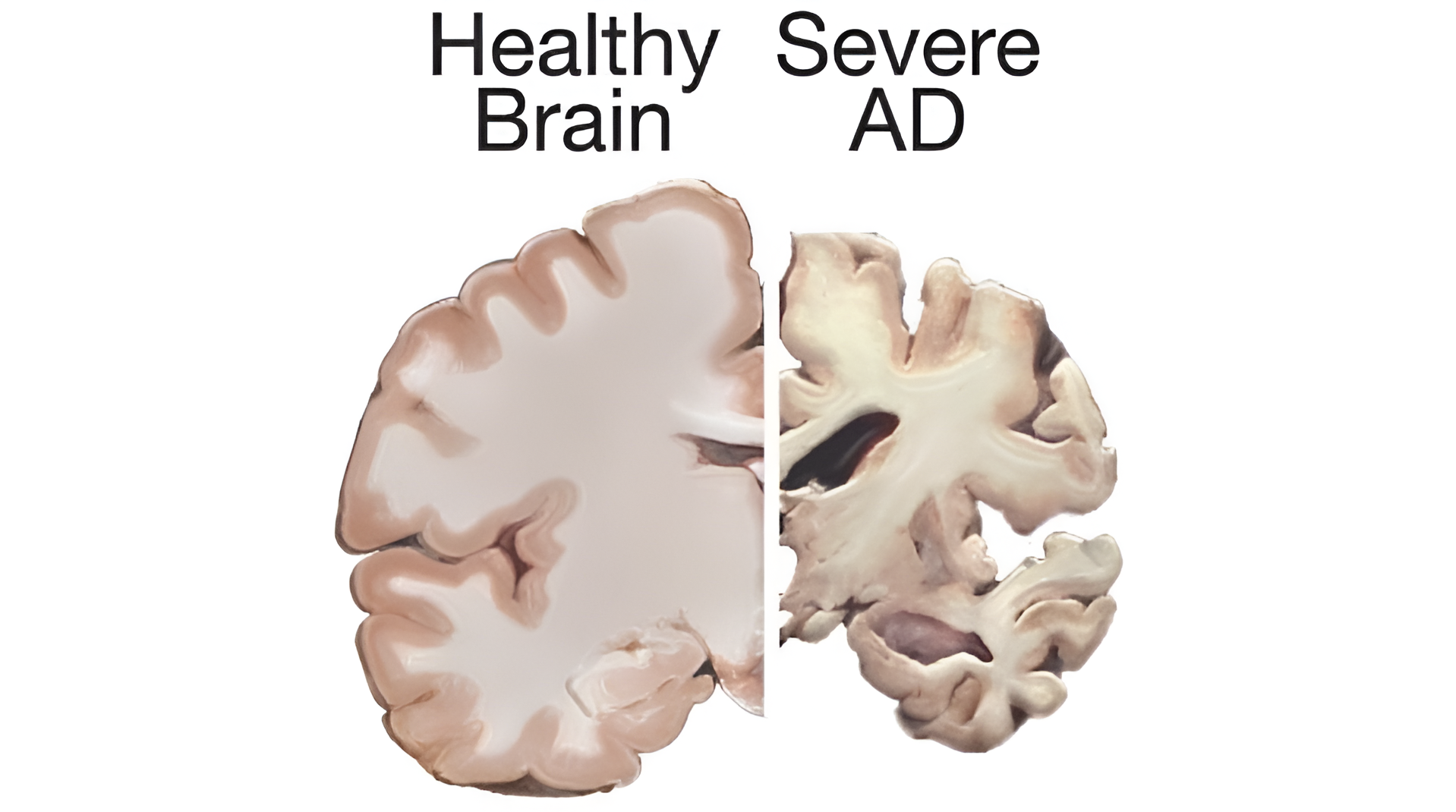 Healthy vs Alzheimer Brain